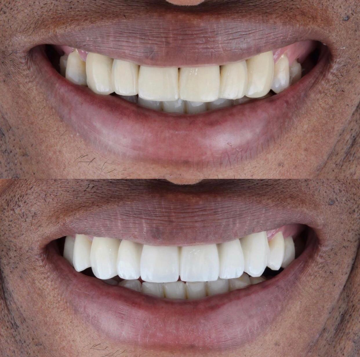 Implant dentaire : quels sont les critères de sélection ?
