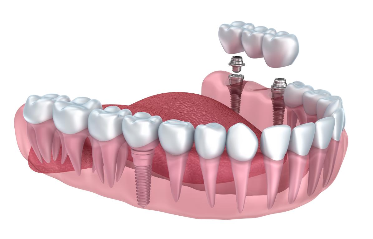 Implant dentaire Lyon : quelles sont les techniques utilisées ?